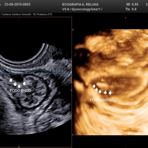 Pequeno foco de Endometriose localizado no septo R-V do bordo anal em 2D/3D
